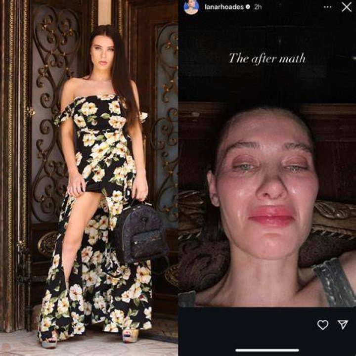 Lana Rhoades Before And After Plastic Surgery
