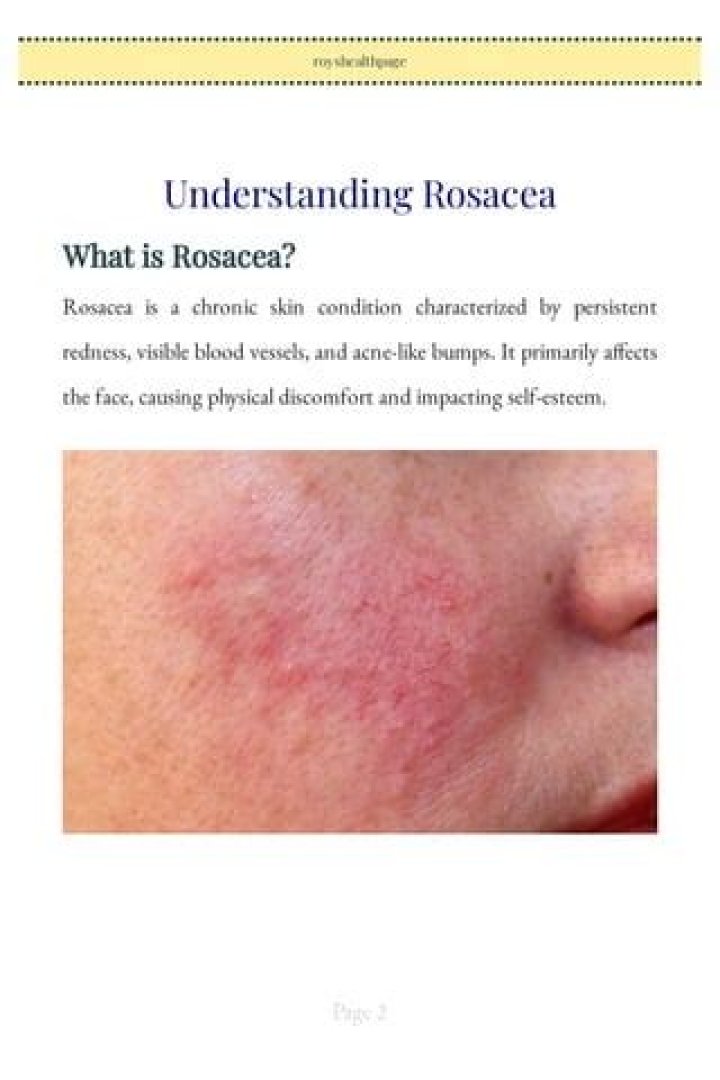 Unlocking The Secrets Of Rosacea: Insights And Discoveries For Healthy Skin